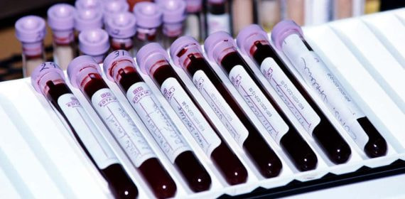 Imagen de unos análisis de sangre.