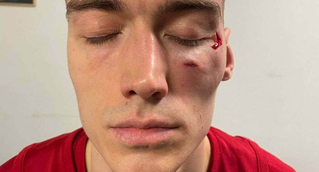 Así ha quedado Lazarevic tras ser agredido.