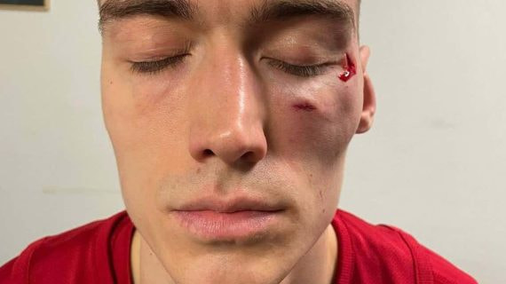 Así ha quedado Lazarevic tras ser agredido.