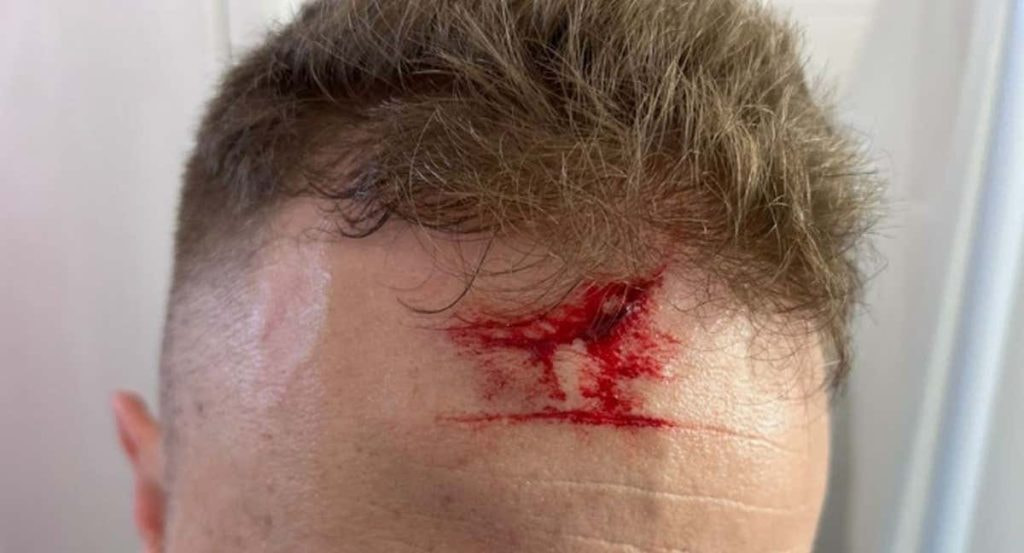 Imagen de la frente del árbitro agredido.