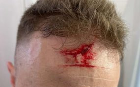 Imagen de la frente del árbitro agredido.
