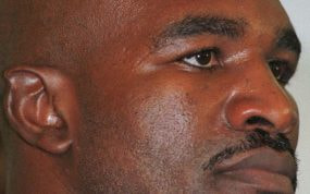 Holyfield con su oreja mordida.